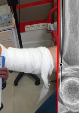 Kocaeli&rsquo;de Akılalmaz Olay! Bayramda Kesilen Parmak Hayatını Kararttı
