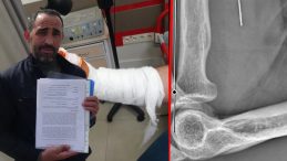 Kocaeli&rsquo;de Akılalmaz Olay! Bayramda Kesilen Parmak Hayatını Kararttı