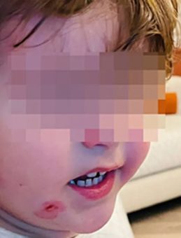 Kreşe bıraktığı çocuğunu darp edilmiş olarak geri aldı!