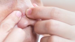 Sivilce Sıkmak Tehlikeli mi? Sosyal Medyada G&ouml;r&uuml;p Denemeyin