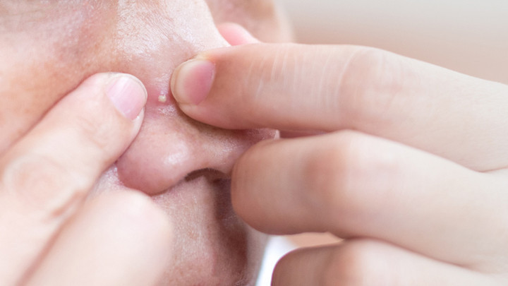 Sivilce Sıkmak Tehlikeli mi? Sosyal Medyada G&ouml;r&uuml;p Denemeyin